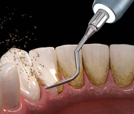 How a Dental Plaque Removal Tool can keep your Teeth Healthy